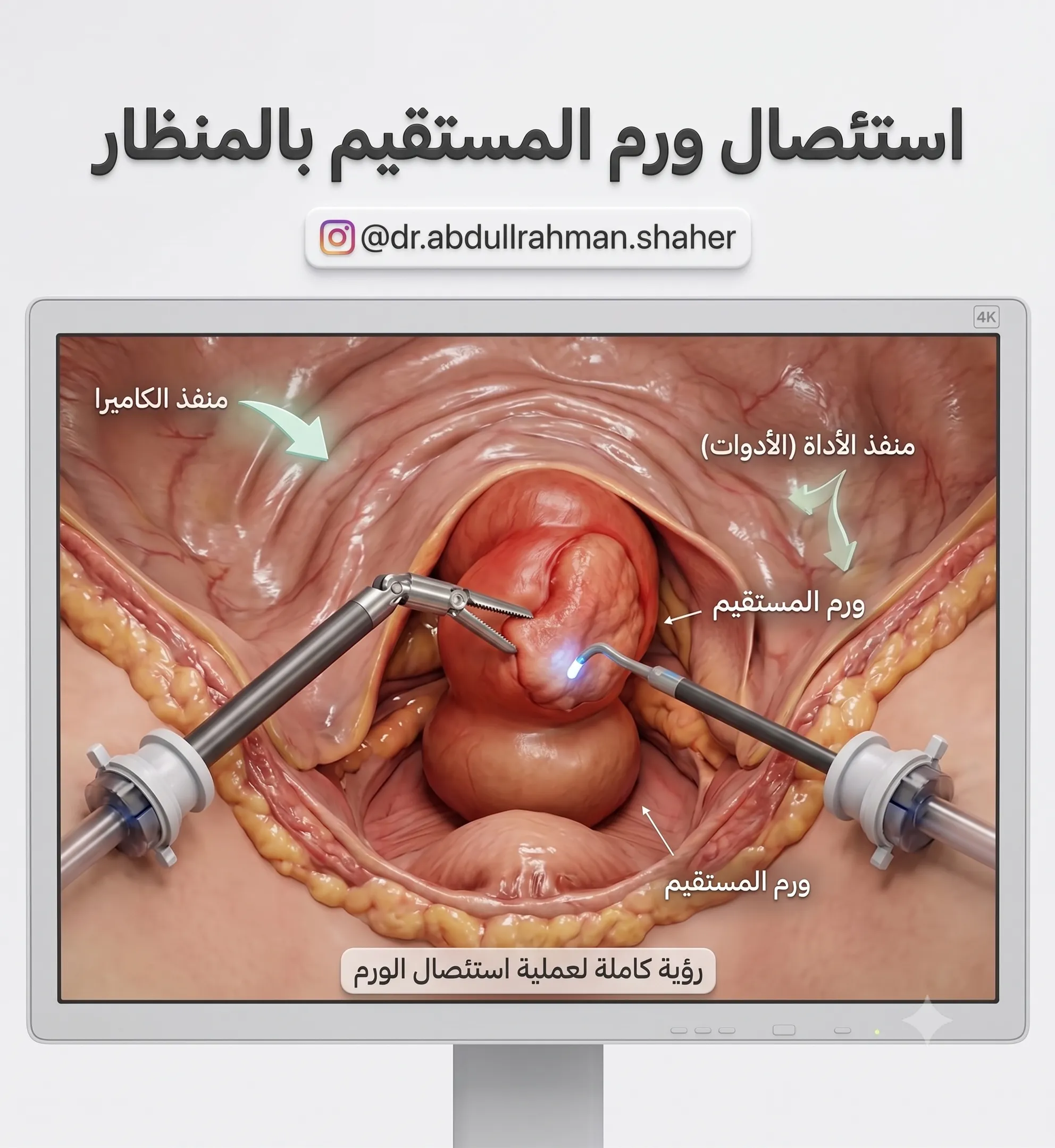 إزالة أورام المستقيم