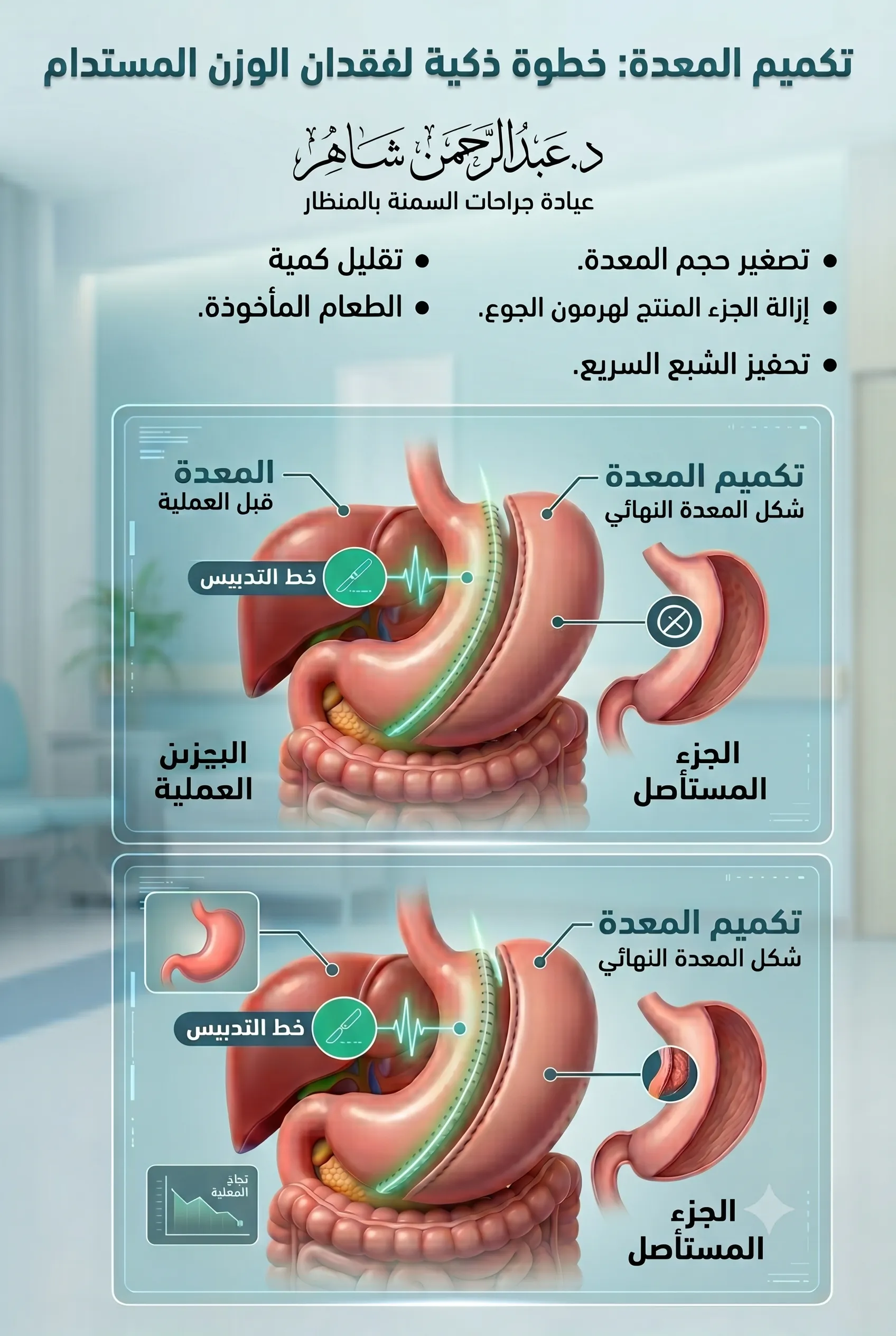 تكميم المعدة