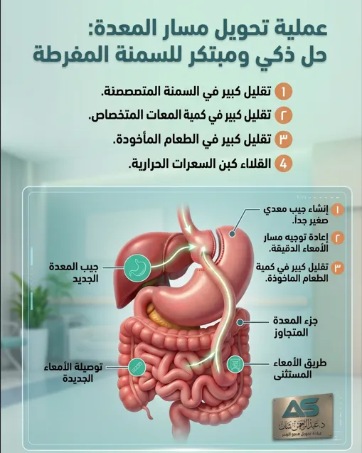 تحويل مسار المعدة
